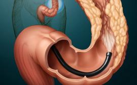 Surgical treatment of colon tumor