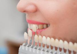 Information About Dental Veneers