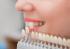 Information About Dental Veneers photo