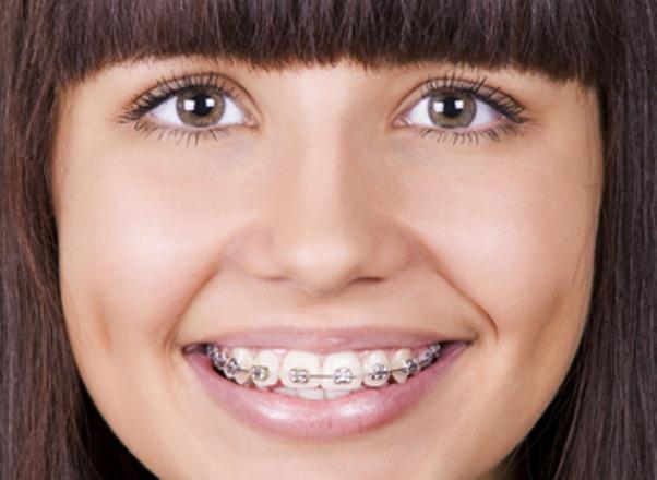 What you should know about lingual braces?