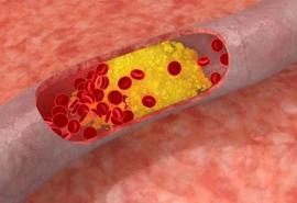 Making A Healthy Lifestyle By Understanding Cholesterol Control