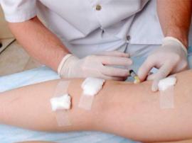 Causes And Treatment Options For Varicose Veins