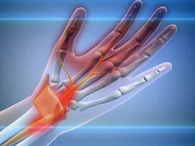 Carpal Tunnel Syndrome: Help yourself