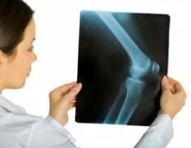Signs and Symptoms of Osteo Arthritis