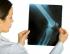 Signs and Symptoms of Osteo Arthritis photo